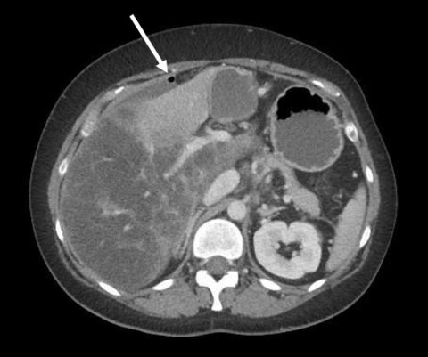 Just another hollow-organ perforation?