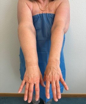 Lymphatic microsurgery