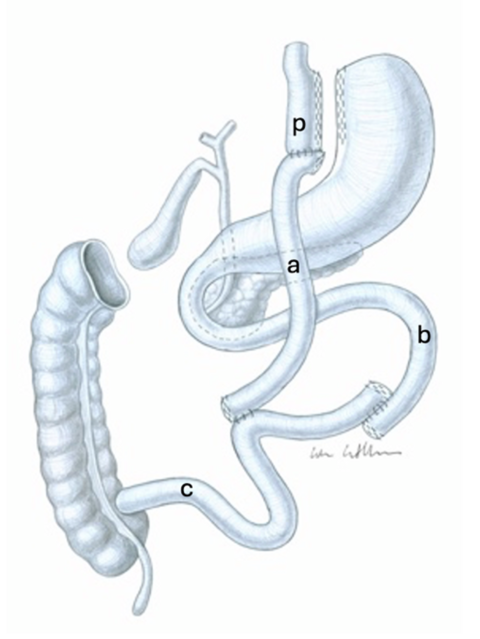 Limb Length Matters in Gastric Bypass Surgery